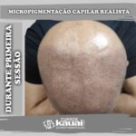 Curso de Micropigmentação capilar realista