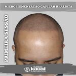 Resultado da Micropigmentação Capilar Realista