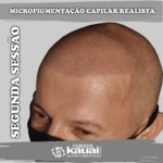 Resultado da Micropigmentação Capilar Realista